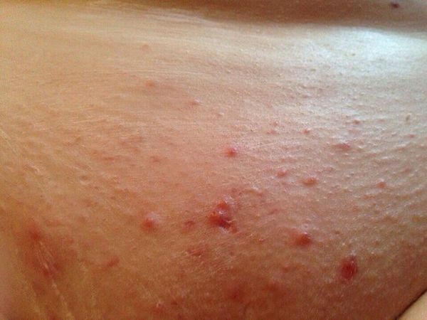 Прыщи после шугаринга: причины появления и способы лечения