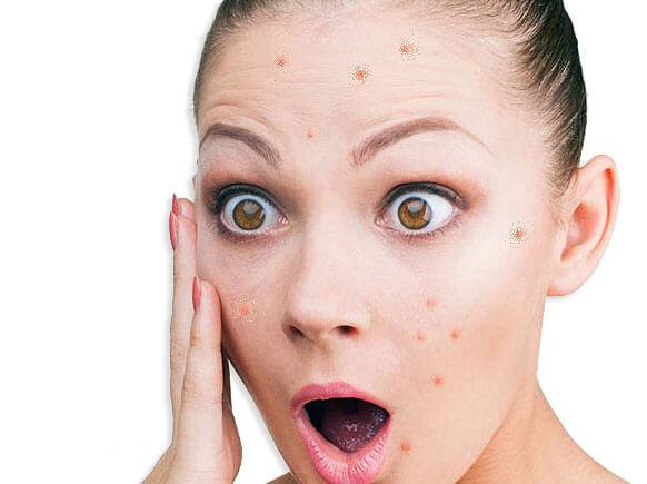 Прыщи при дисбактериозе кишечника: лечение болезни