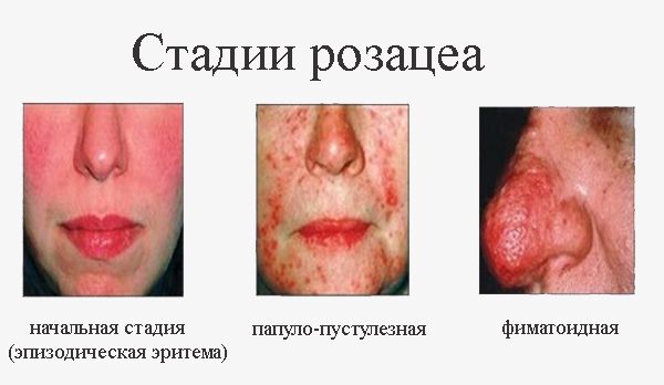 Розовые угри: особенность воспаления и этапы лечения
