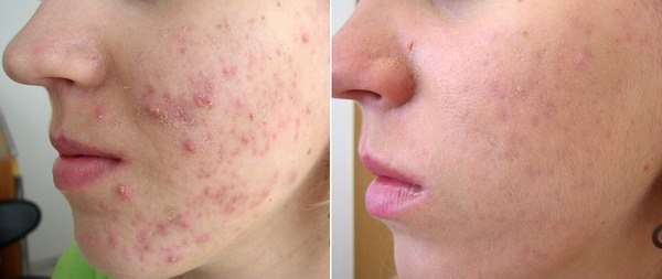 Салициловая мазь от прыщей – универсальное средство для кожи