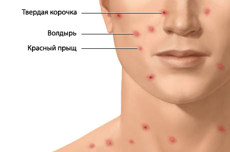 Симптомы ветрянки: как вовремя обнаружить инфекцию