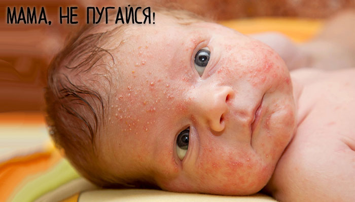 Сыпь на лице у новорожденного: основные причины