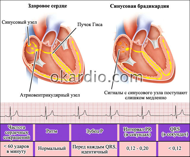 Умеренная брадикардия: что это такое и как ее лечить