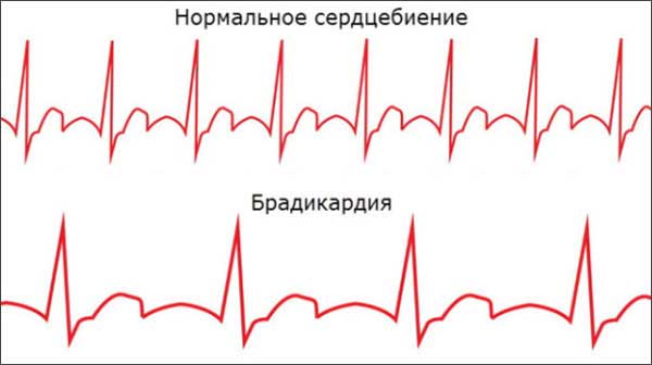 Умеренная брадикардия: что это такое и как ее лечить