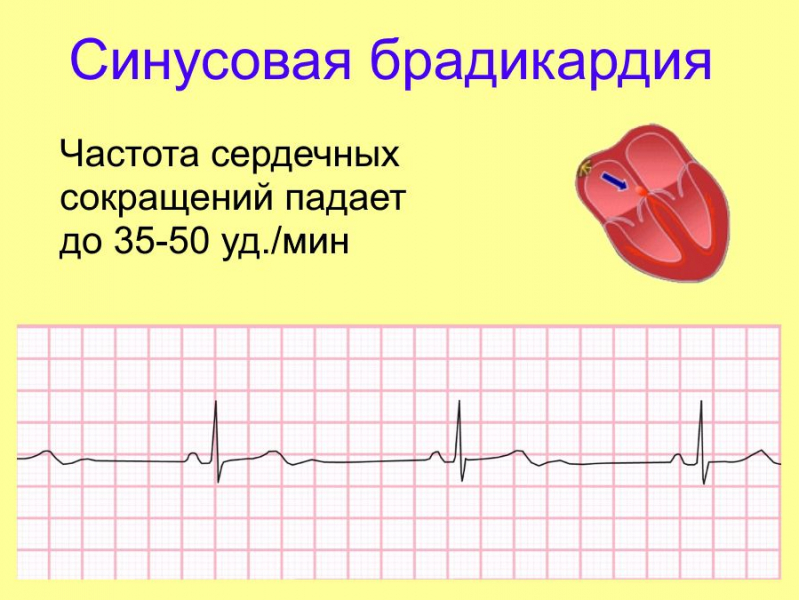 Умеренная брадикардия: что это такое и как ее лечить