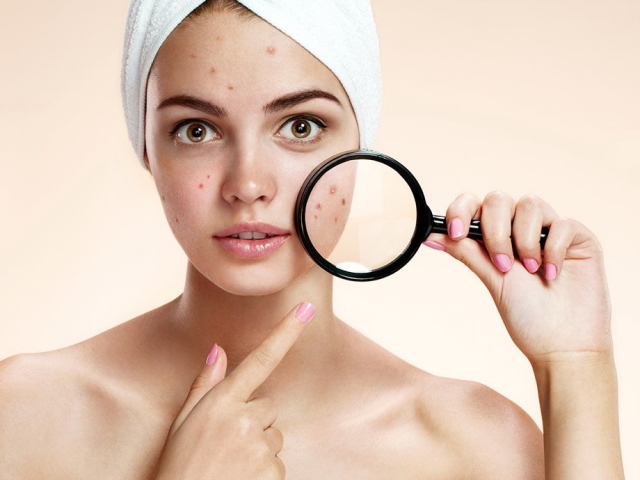 Узнай, как избавиться от прыщей и улучшить состояние кожи