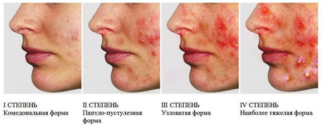 Виды прыщей на лице: виды, лечение
