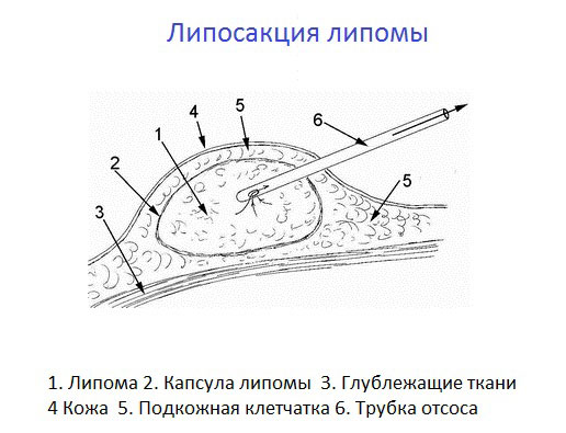 Жировики на члене: как лечить в домашних условиях?