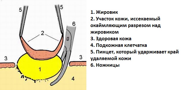 Жировики на яичках: в чем опасность липомы на мошонке