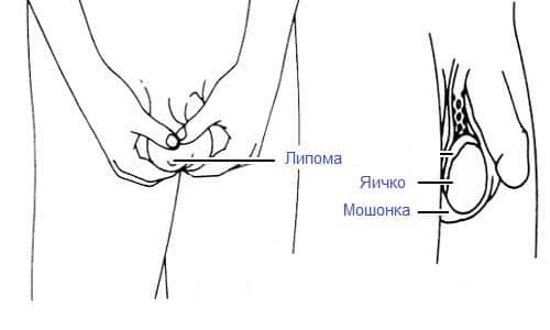 Жировики на яичках: в чем опасность липомы на мошонке